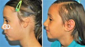 Microtia