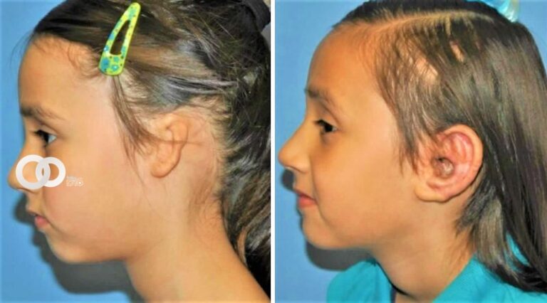 Microtia