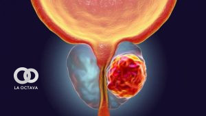 Cáncer de Próstata