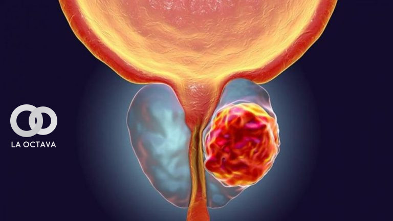 Cáncer de Próstata