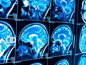 Frecuencia del sistema neurológico por Covid-19.