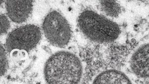OMS confirma 257 casos confirmados de "Viruela del Mono" en el mundo