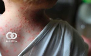 Niño diagnosticado con la viruela del mono