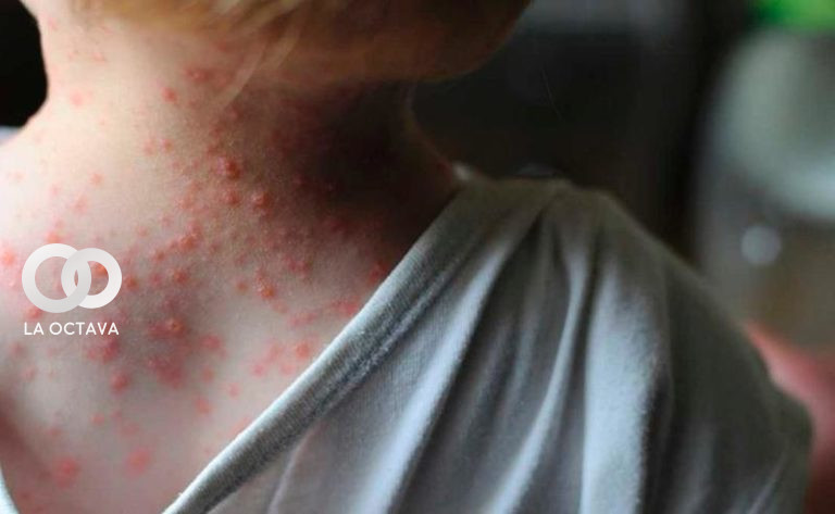 Niño diagnosticado con la viruela del mono