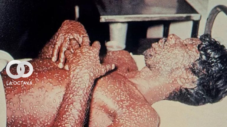 Viruela del mono; causa el mayor brote jamás visto en Europa