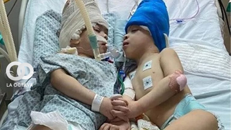 Una pareja de gemelos que estaban unidos por sus cabezas